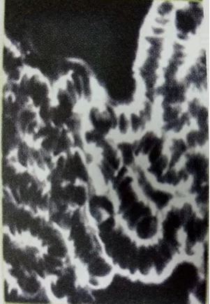 Sel Darah Menggumpal